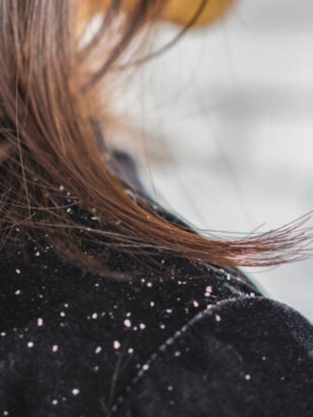 Top 7 Ways to get rid of dandruff