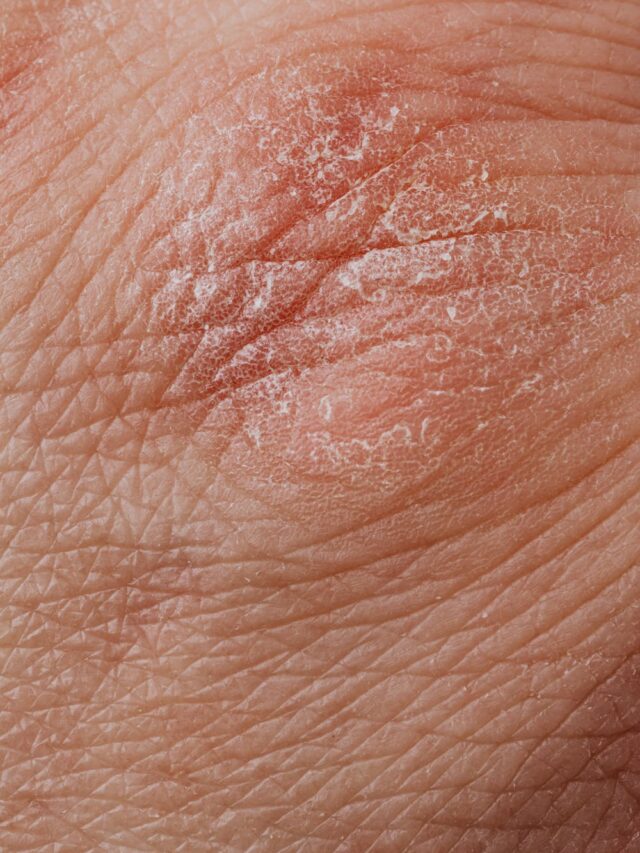 Dry Skin